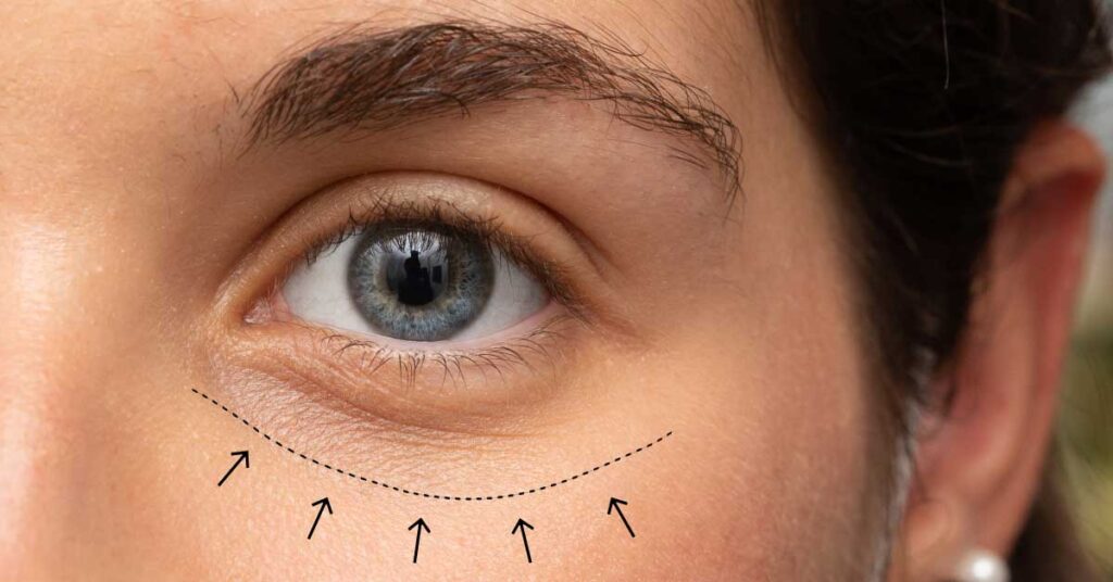Blefaroplastia: rejuvenece tu mirada y mejora tu bienestar visual