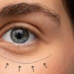 Blefaroplastia: rejuvenece tu mirada y mejora tu bienestar visual